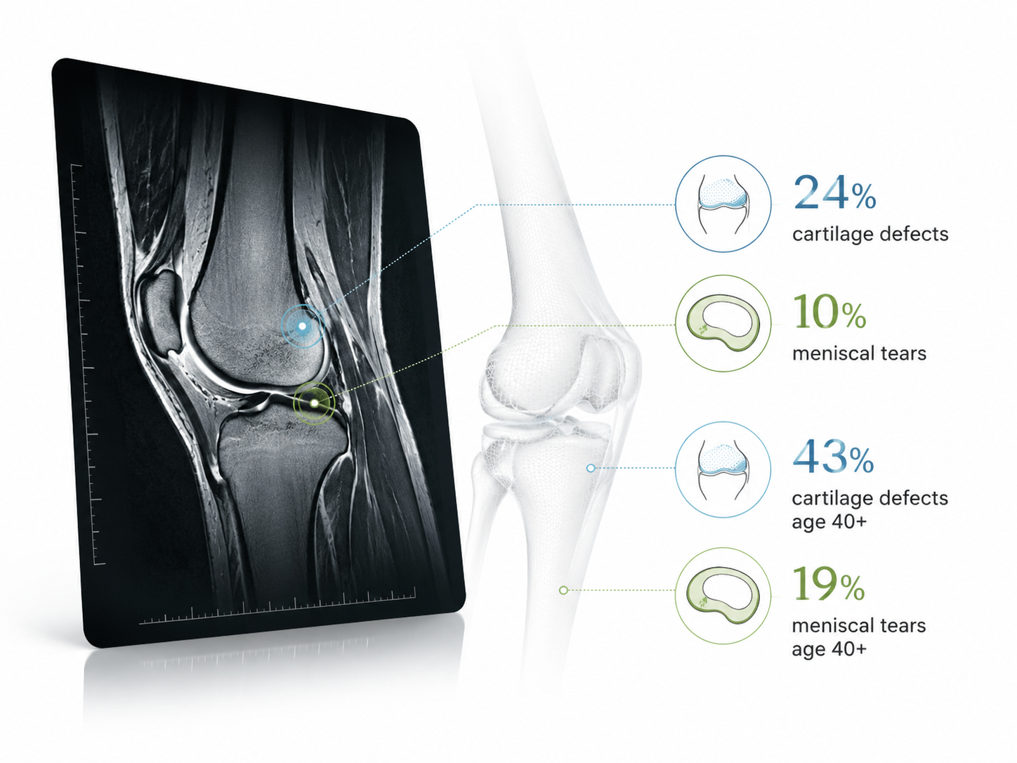 Knee MRI findings showing cartilage defects and meniscal tear statistics